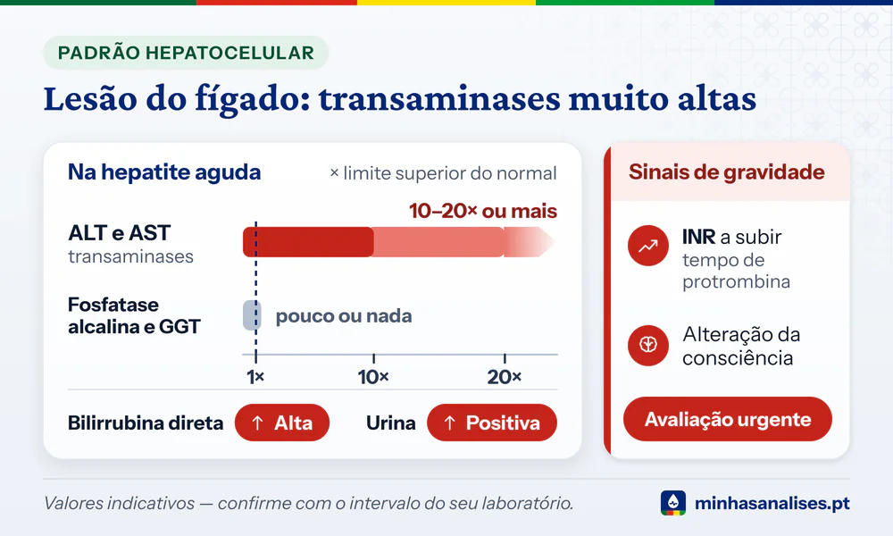 Padrão hepatocelular em barras: ALT e AST 10 a 20 vezes o limite ou mais, fosfatase e GGT quase normais, urina positiva