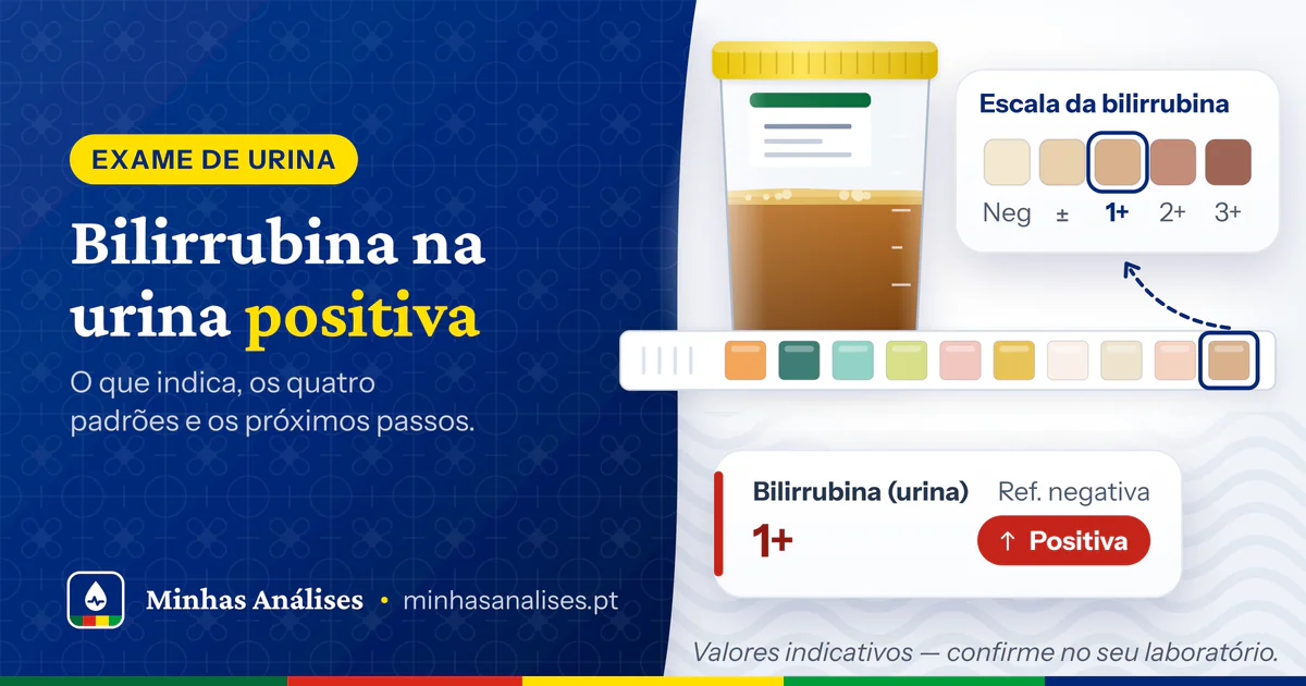 Tira reativa com a almofada da bilirrubina castanha, frasco de urina escura e resultado de bilirrubina 1+ positiva