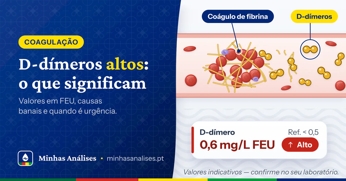 Coágulo de fibrina num vaso a desfazer-se em fragmentos de D-dímero e resultado de 0,6 mg/L FEU assinalado como alto