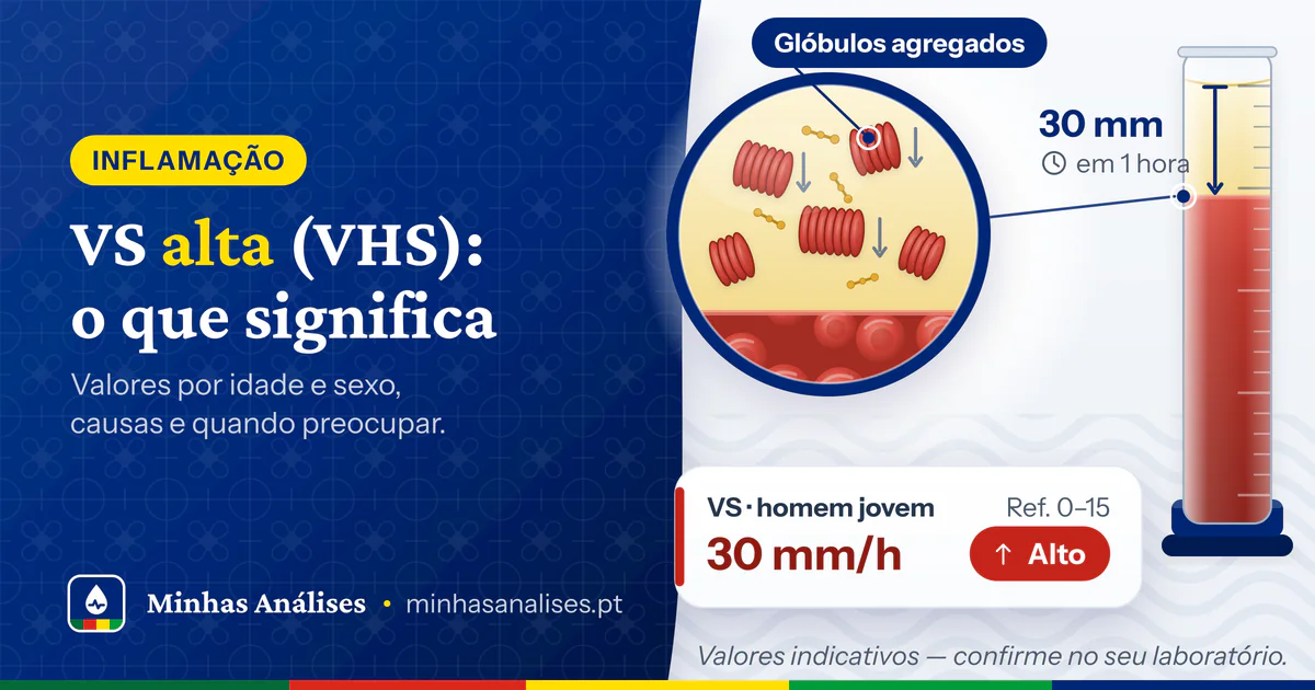 Tubo da velocidade de sedimentação com plasma sobre os glóbulos vermelhos, glóbulos em pilha ampliados e VS de 30 mm/h alta